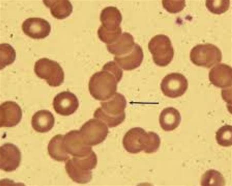 formation rolex|rouleaux formation multiple myeloma.